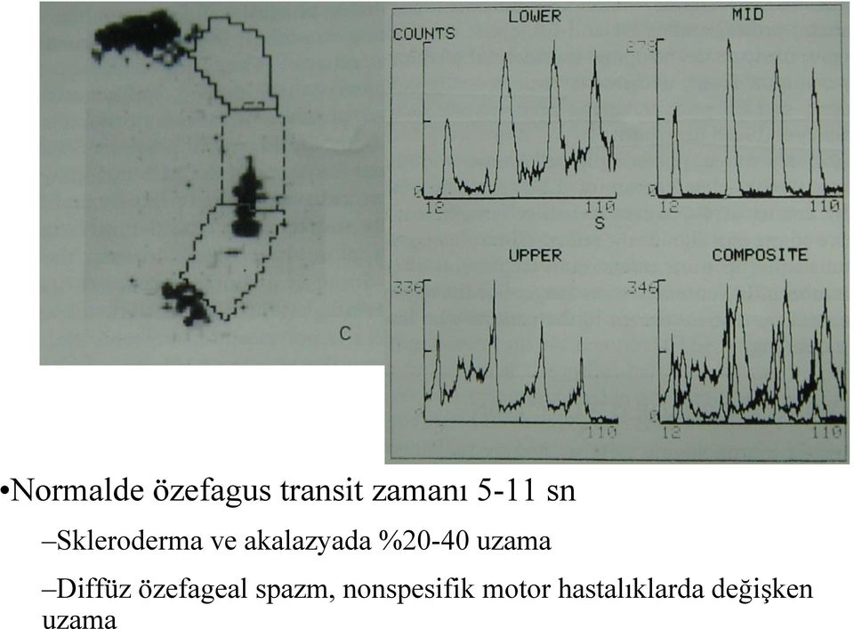 uzama Diffüz özefageal spazm,