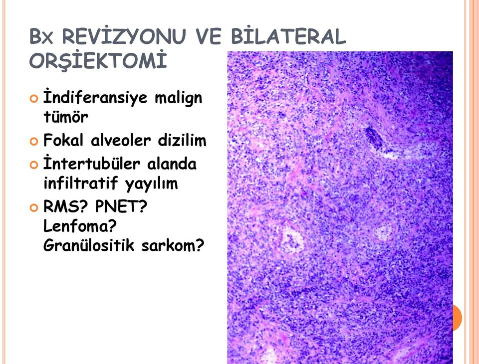 dizilim İntertubüler alanda infiltratif