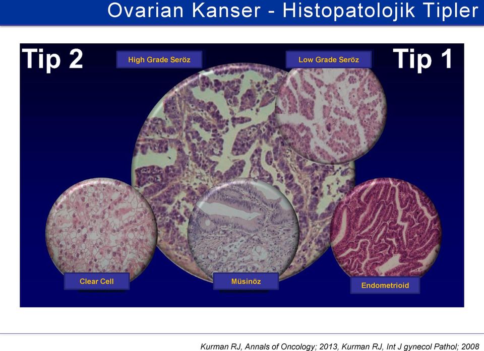 Müsinöz Endometrioid Kurman RJ, Annals of