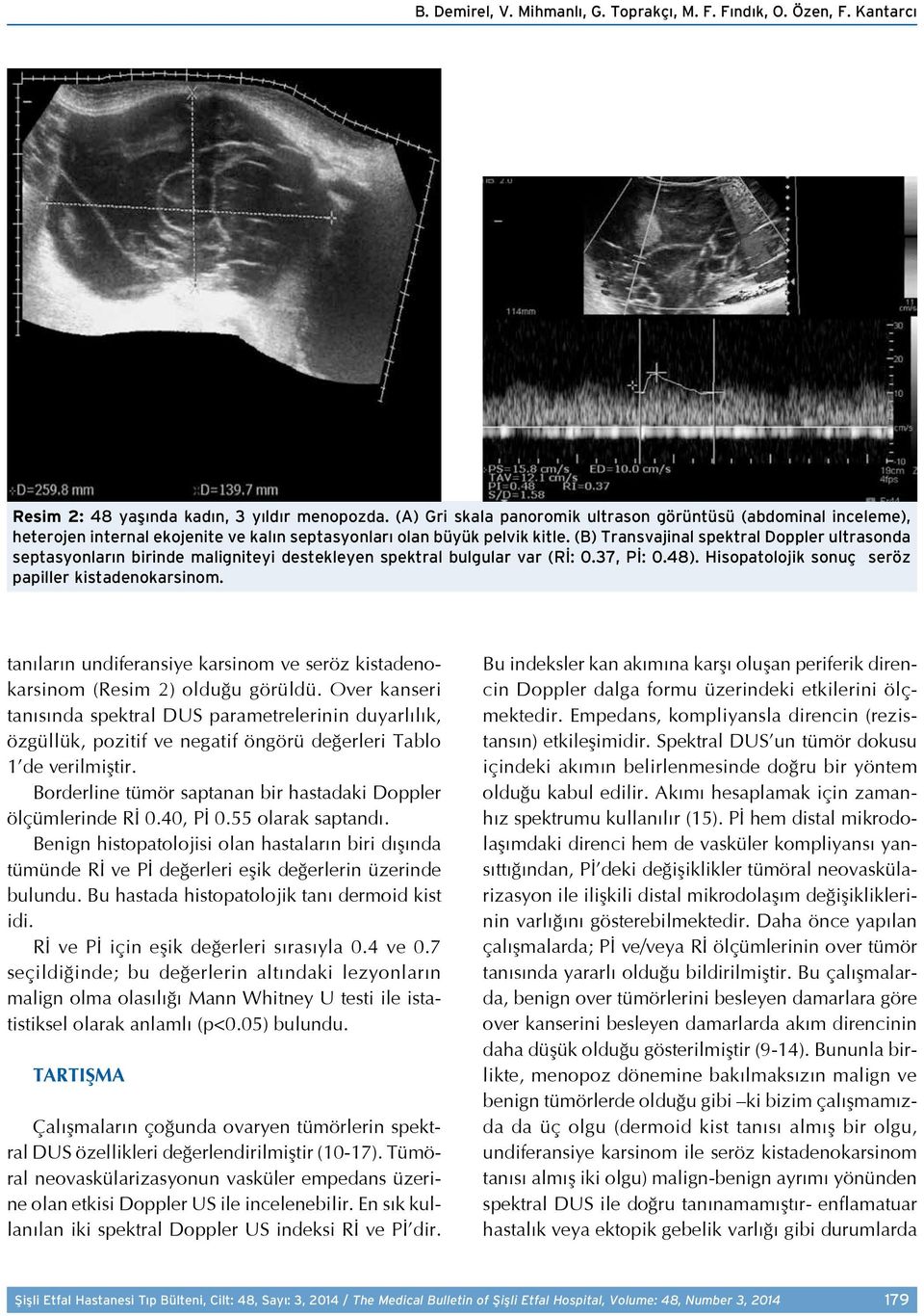 (B) Transvajinal spektral Doppler ultrasonda septasyonların birinde maligniteyi destekleyen spektral bulgular var (Rİ: 0.37, Pİ: 0.48). Hisopatolojik sonuç seröz papiller kistadenokarsinom.