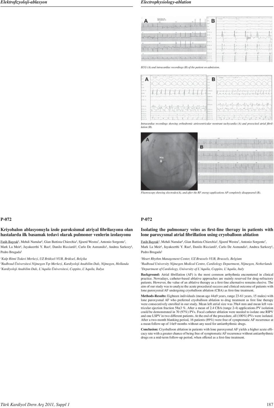 Fluoroscopy showing electrodes(a), and after the RF energy applications AP completely disappeared (B).