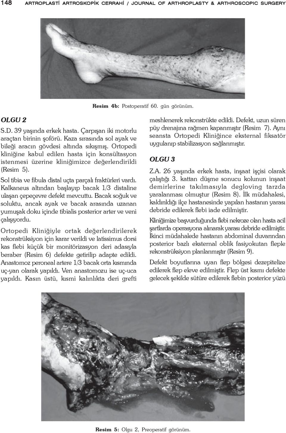 Ortopedi kliniðine kabul edilen hasta için konsültasyon istenmesi üzerine kliniðimizce deðerlendirildi (Resim 5). Sol tibia ve fibula distal uçta parçalý fraktürleri vardý.