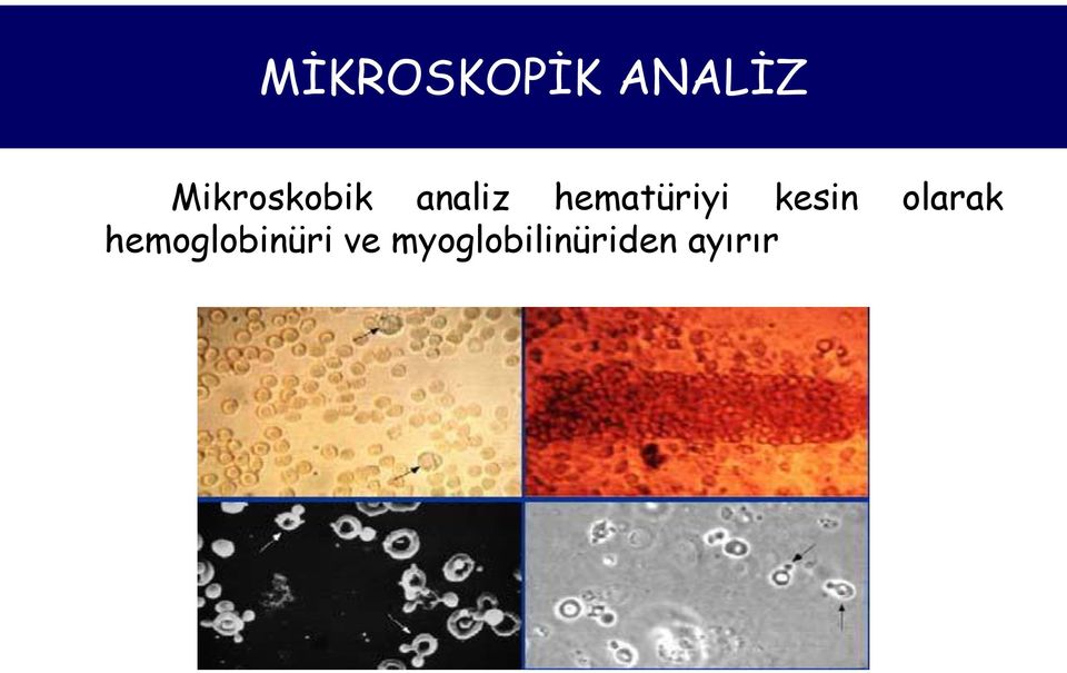 hematüriyi kesin olarak