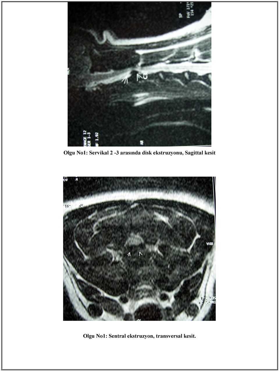 Sagittal kesit Olgu No1: