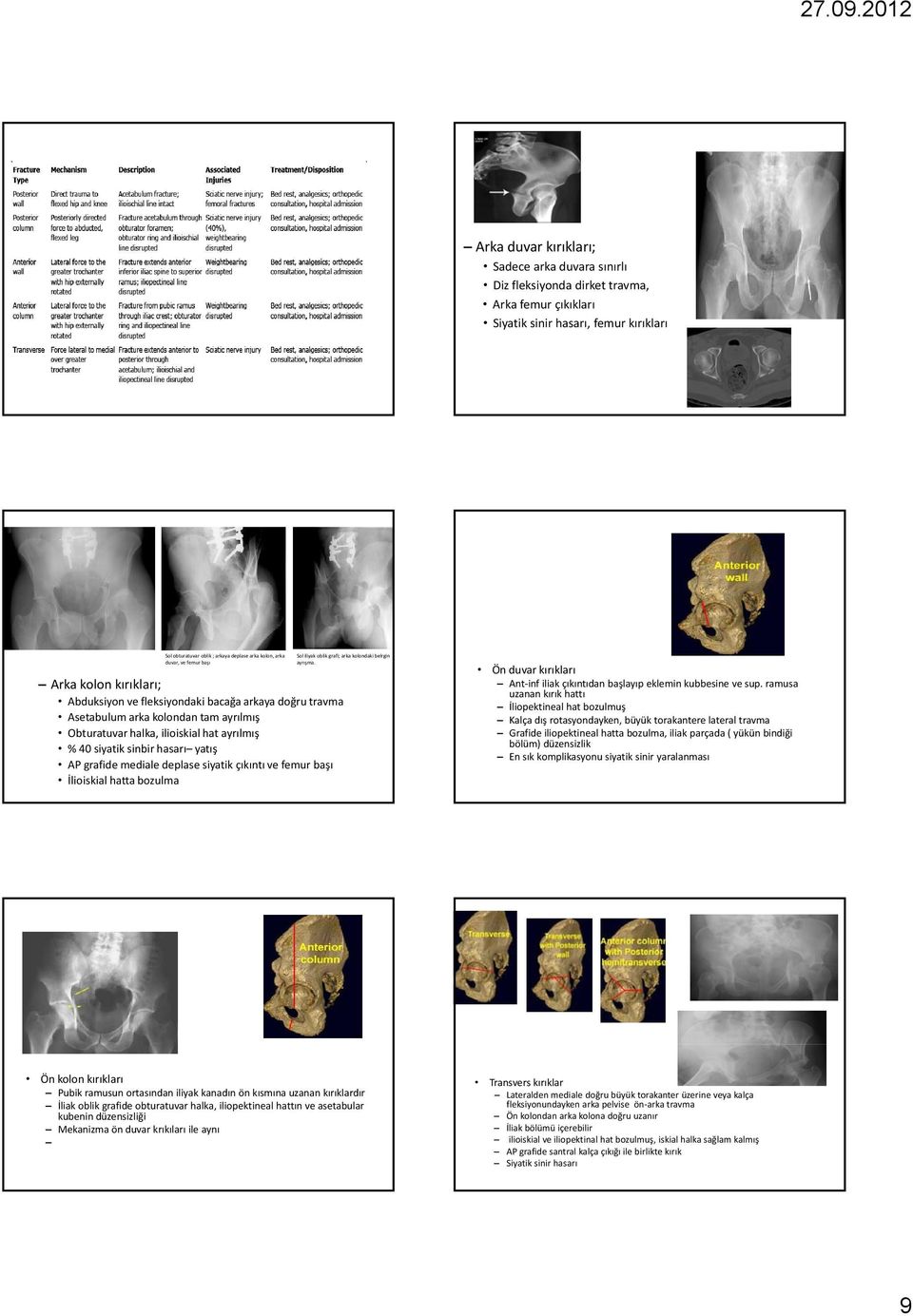 Arka kolon kırıkları; Abduksiyon ve fleksiyondaki bacağa arkaya doğru travma Asetabulum arka kolondan tam ayrılmış Obturatuvar halka, ilioiskial hat ayrılmış % 40 siyatik sinbir hasarı yatış AP