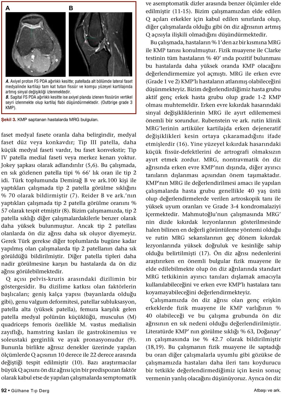 faset medyal fasete oranla daha belirgindir, medyal faset düz veya konkavdır; Tip III patella, daha küçük medyal faseti vardır, bu faset konvekstir; Tip IV patella medial faseti veya merkez kenarı