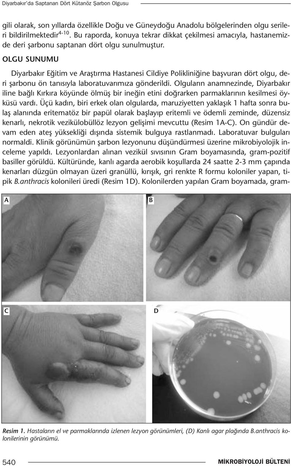 OLGU SUNUMU Diyarbakır Eğitim ve Araştırma Hastanesi Cildiye Polikliniğine başvuran dört olgu, deri şarbonu ön tanısıyla laboratuvarımıza gönderildi.