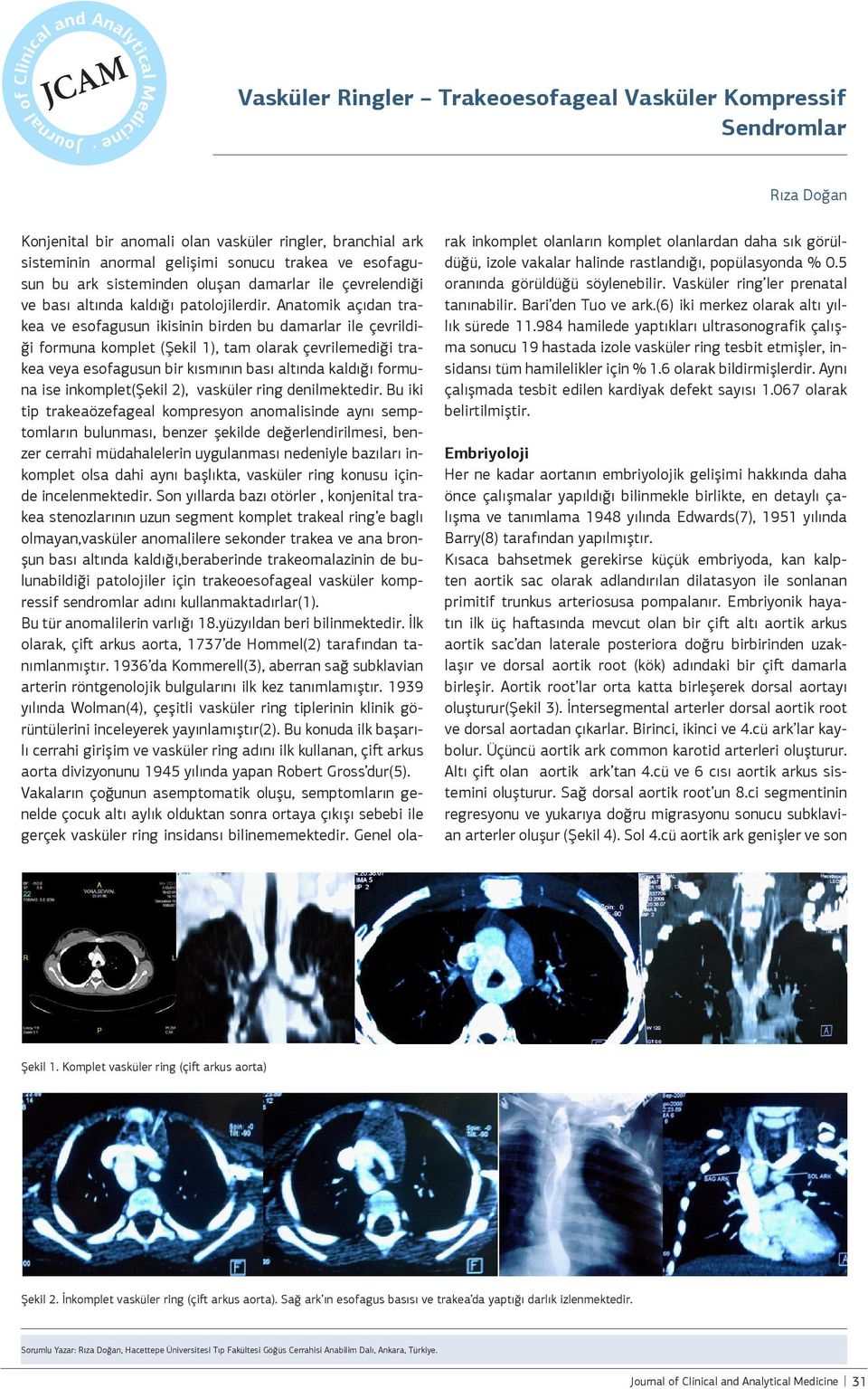 Anatomik açıdan trakea ve esofagusun ikisinin birden bu damarlar ile çevrildiği formuna komplet (Şekil 1), tam olarak çevrilemediği trakea veya esofagusun bir kısmının bası altında kaldığı formuna