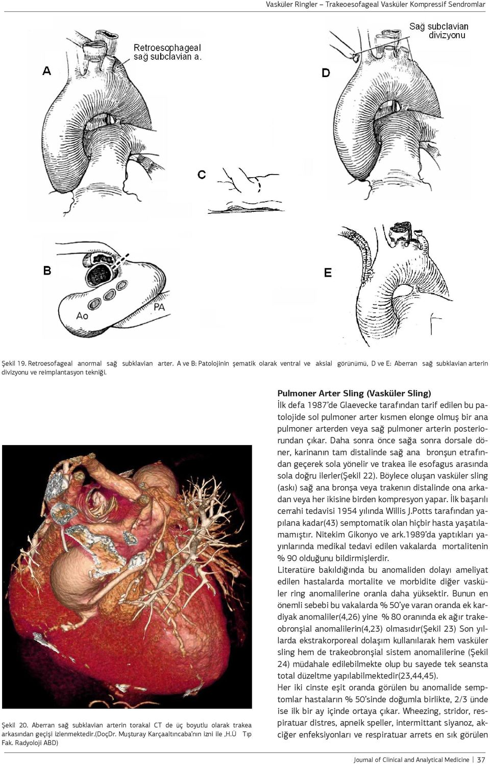 Radyoloji ABD) Pulmoner Arter Sling (Vasküler Sling) İlk defa 1987 de Glaevecke tarafından tarif edilen bu patolojide sol pulmoner arter kısmen elonge olmuş bir ana pulmoner arterden veya sağ
