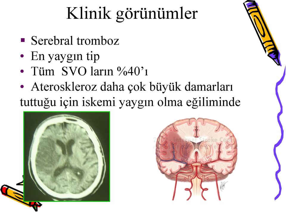 Ateroskleroz daha çok büyük damarları