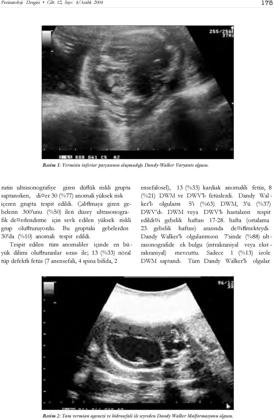 Çal flmaya giren gebelerin 300 unu (%50) ileri düzey ultrasonografik de erlendirme için sevk edilen yüksek riskli grup oluflturuyordu. Bu gruptaki gebelerden 30 da (%10) anomali tespit edildi.