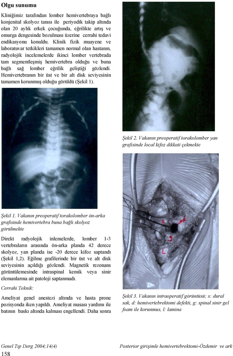 Klinik fizik muayene ve laboratuvar tetkikleri tamamen normal olan hastanın, radyolojik incelemelerde ikinci lomber vertebrada tam segmentleşmiş hemivertebra olduğu ve buna bağlı sağ lomber eğrilik