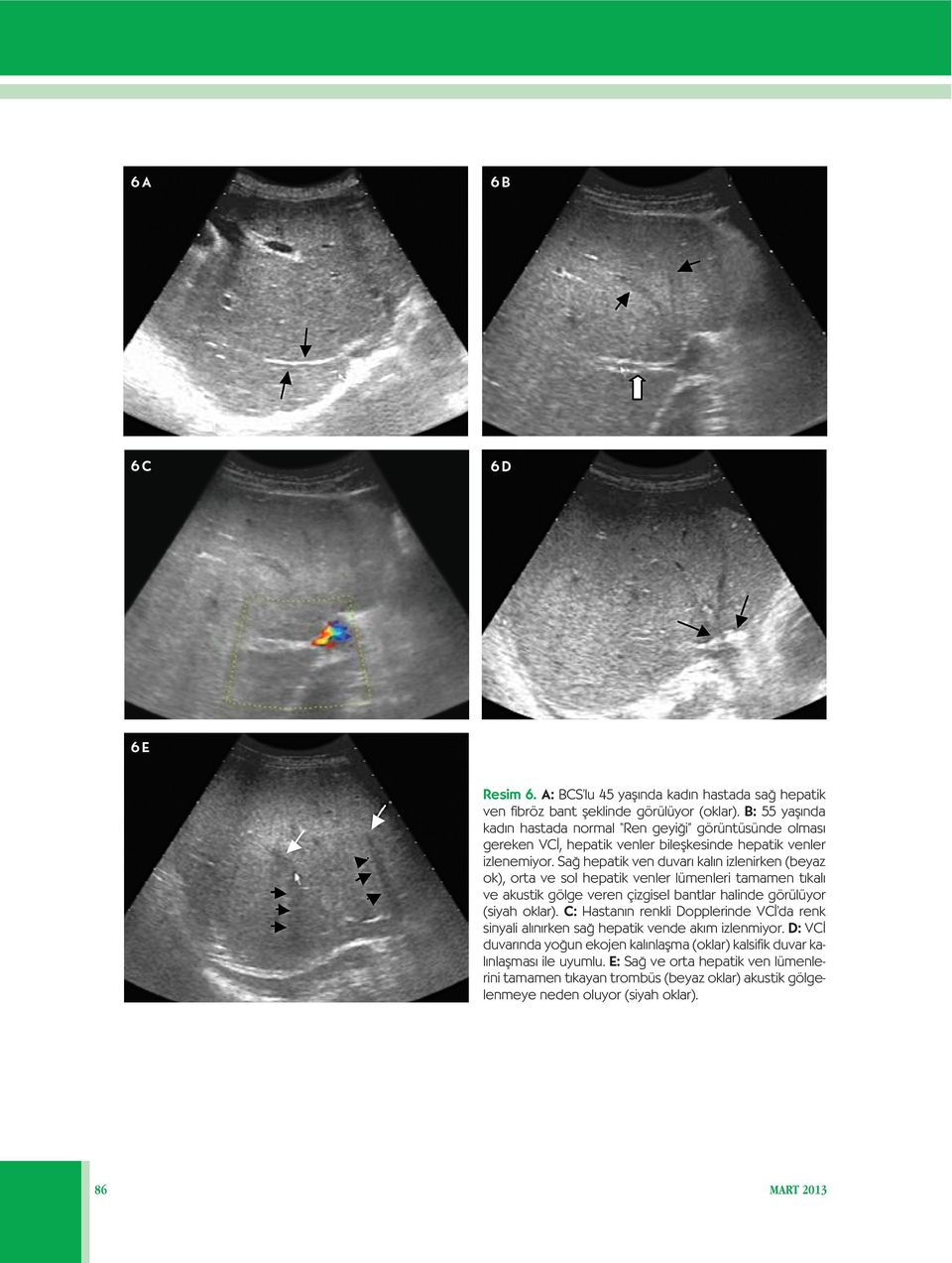 Sa hepatik ven duvar kal n izlenirken (beyaz ok), orta ve sol hepatik venler lümenleri tamamen t kal ve akustik gölge veren çizgisel bantlar halinde görülüyor (siyah oklar).