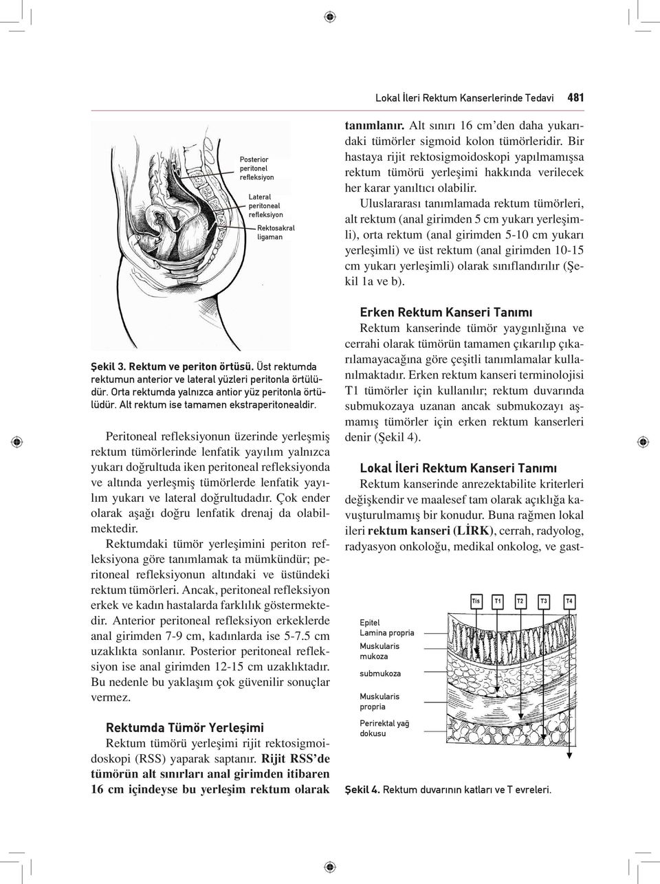 Peritoneal refleksiyonun üzerinde yerleşmiş rektum tümörlerinde lenfatik yayılım yalnızca yukarı doğrultuda iken peritoneal refleksiyonda ve altında yerleşmiş tümörlerde lenfatik yayılım yukarı ve