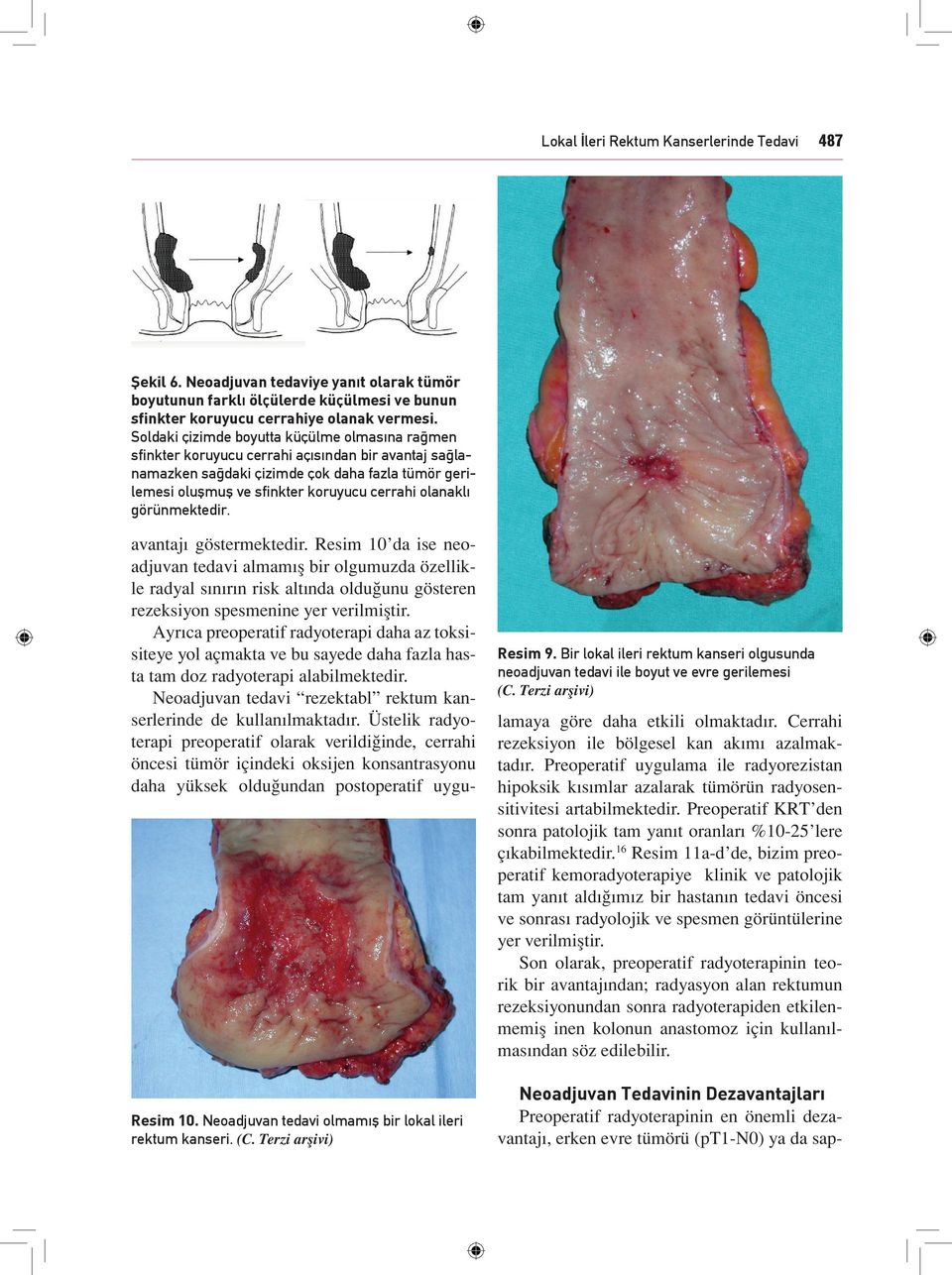 olanaklı görünmektedir. avantajı göstermektedir. Resim 10 da ise neoadjuvan tedavi almamış bir olgumuzda özellikle radyal sınırın risk altında olduğunu gösteren rezeksiyon spesmenine yer verilmiştir.