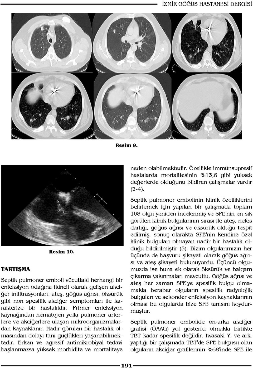 Septik pulmoner emboli vücuttaki herhangi bir enfeksiyon odağına ikincil olarak gelişen akciğer infiltrasyonları, ateş, göğüs ağrısı, öksürük gibi non spesifik akciğer semptomları ile karakterize bir