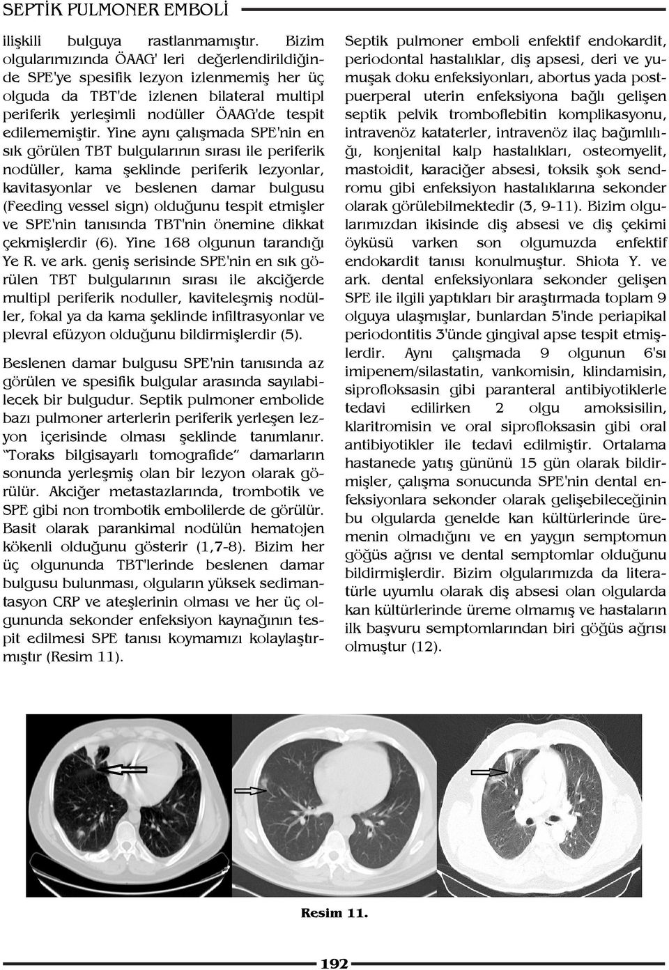 Yine aynı çalışmada SPE'nin en sık görülen TBT bulgularının sırası ile periferik nodüller, kama şeklinde periferik lezyonlar, kavitasyonlar ve beslenen damar bulgusu (Feeding vessel sign) olduğunu