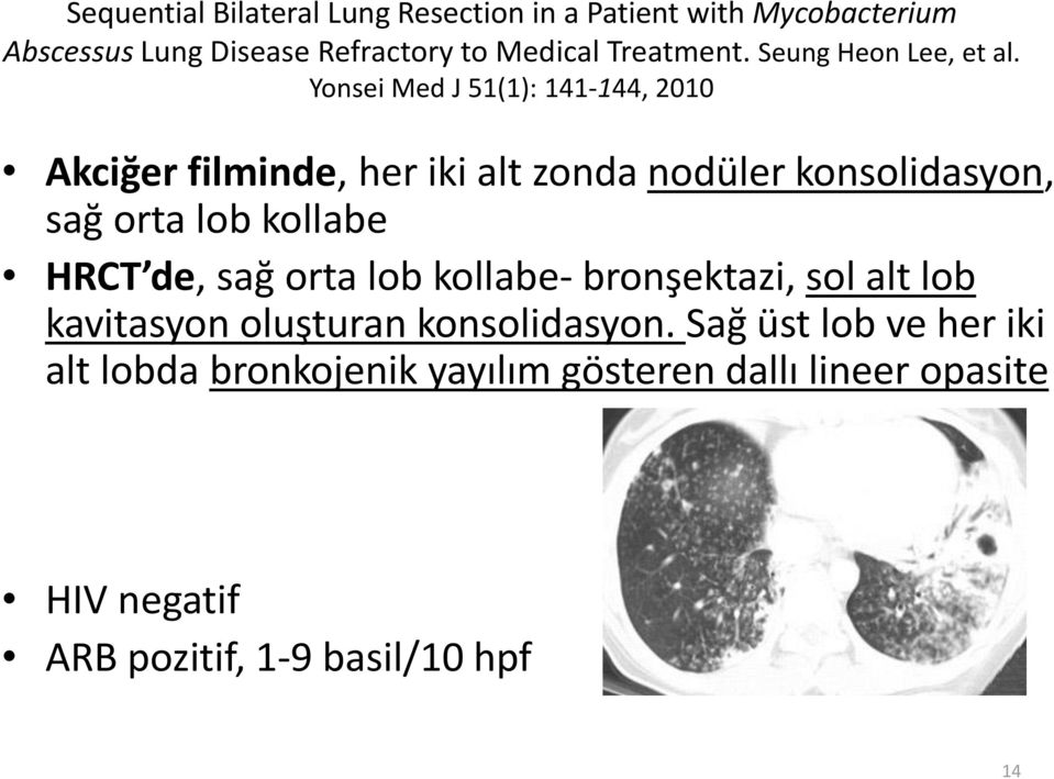 Yonsei Med J 51(1): 141-144, 2010 Akciğer filminde, her iki alt zonda nodüler konsolidasyon, sağ orta lob kollabe HRCT