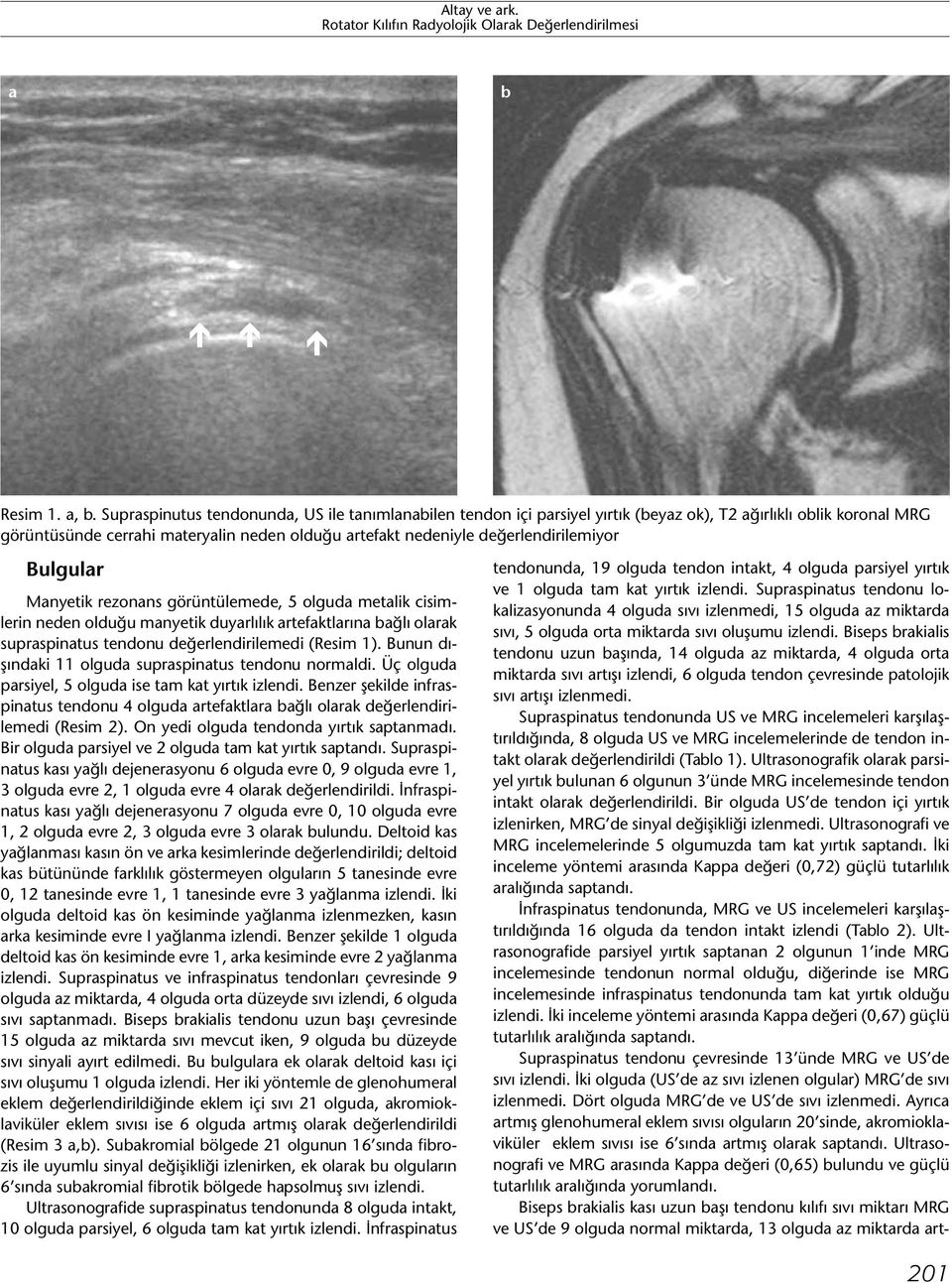 değerlendirilemiyor Bulgular Manyetik rezonans görüntülemede, 5 olguda metalik cisimlerin neden olduğu manyetik duyarlılık artefaktlarına bağlı olarak supraspinatus tendonu değerlendirilemedi (Resim