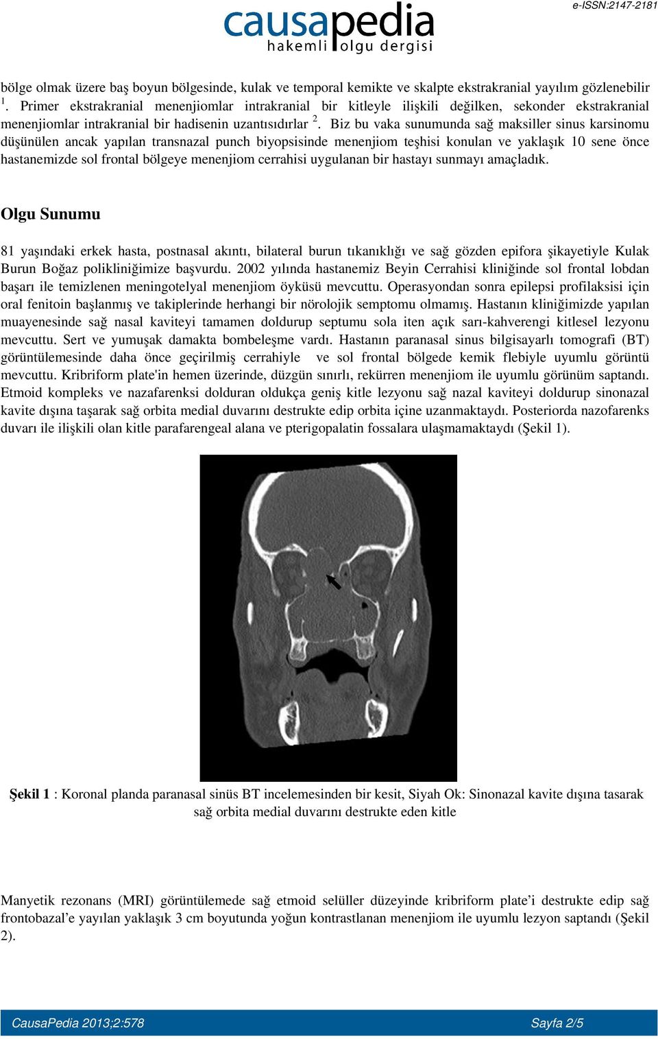 Biz bu vaka sunumunda sağ maksiller sinus karsinomu düşünülen ancak yapılan transnazal punch biyopsisinde menenjiom teşhisi konulan ve yaklaşık 10 sene önce hastanemizde sol frontal bölgeye menenjiom