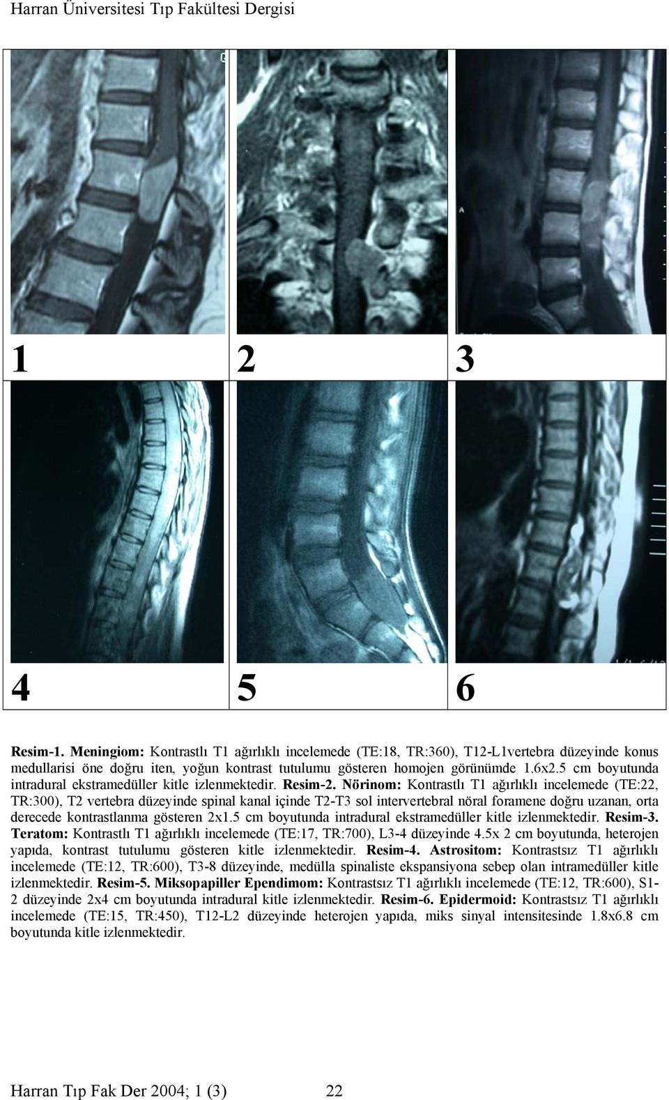 Nörinom: Kontrastlı T1 ağırlıklı incelemede (TE:22, TR:300), T2 vertebra düzeyinde spinal kanal içinde T2-T3 sol intervertebral nöral foramene doğru uzanan, orta derecede kontrastlanma gösteren 2x1.
