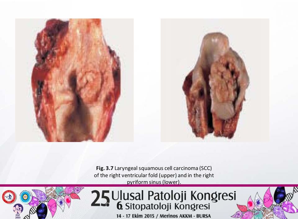 carcinoma (SCC) of the right