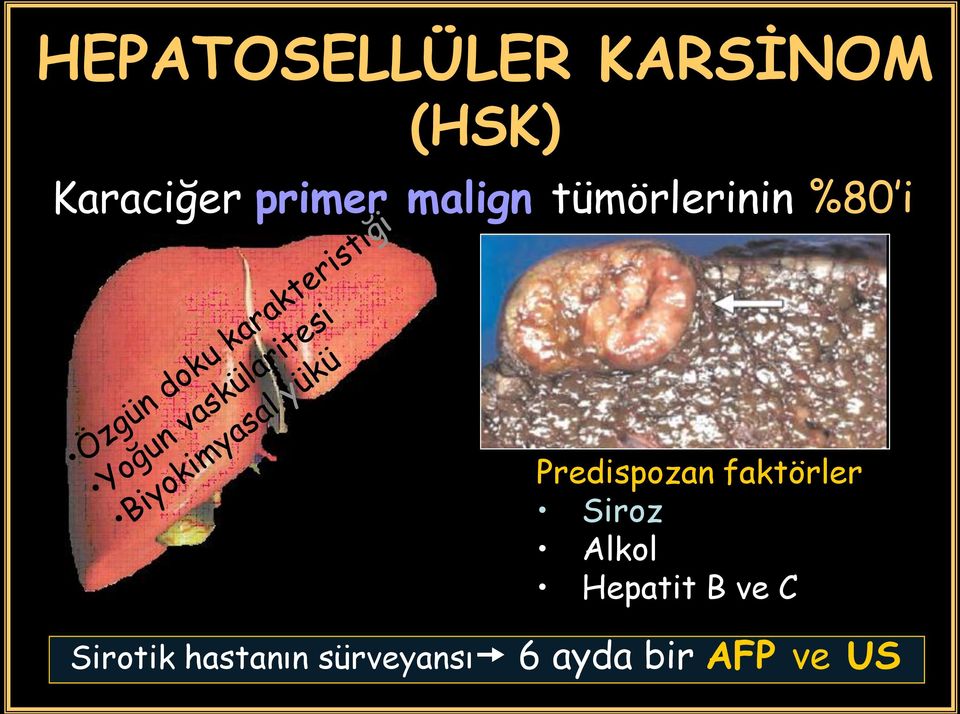 Predispozan faktörler Siroz Alkol Hepatit