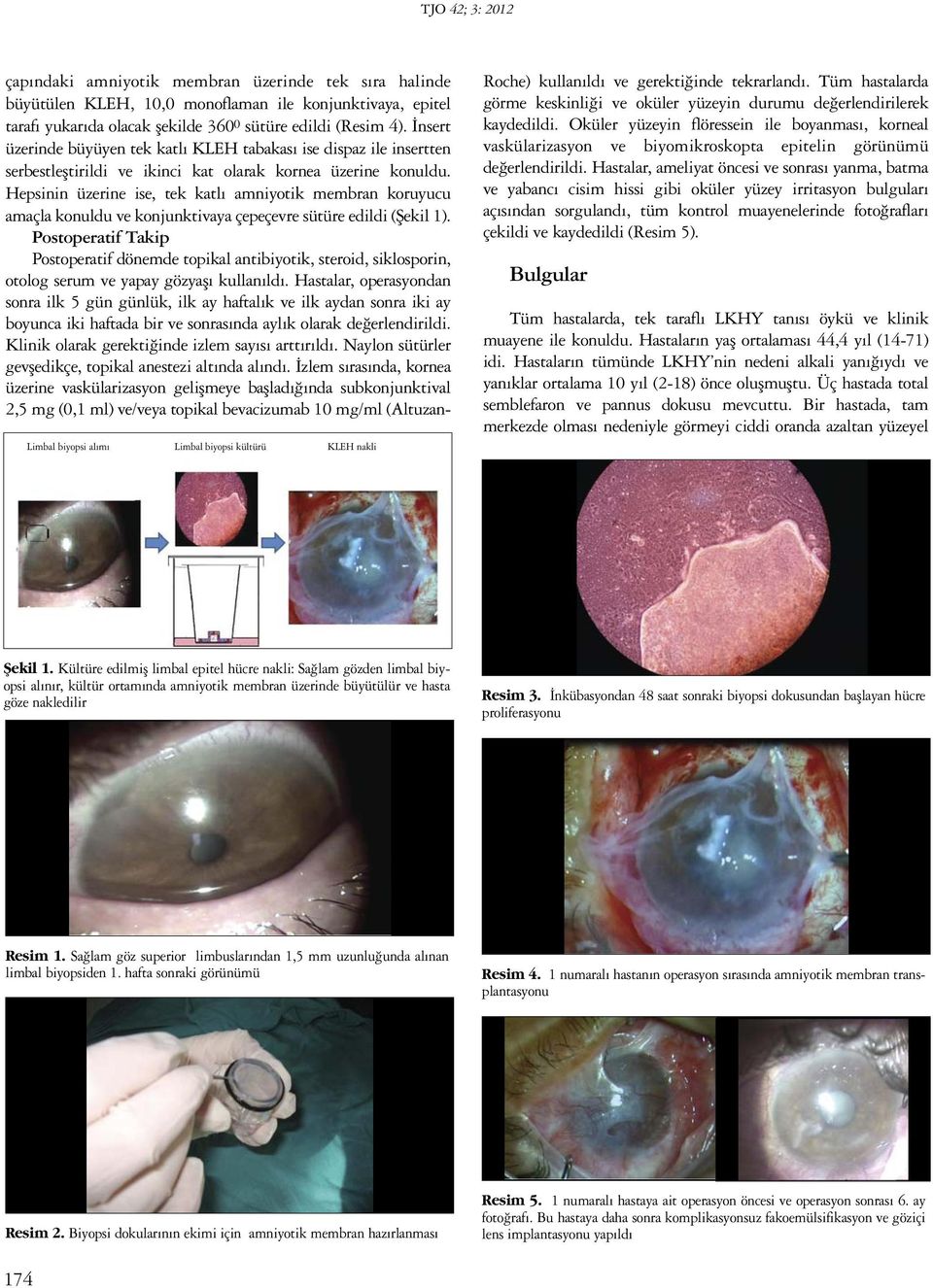 Hepsinin üzerine ise, tek katlı amniyotik membran koruyucu amaçla konuldu ve konjunktivaya çepeçevre sütüre edildi (Şekil 1).