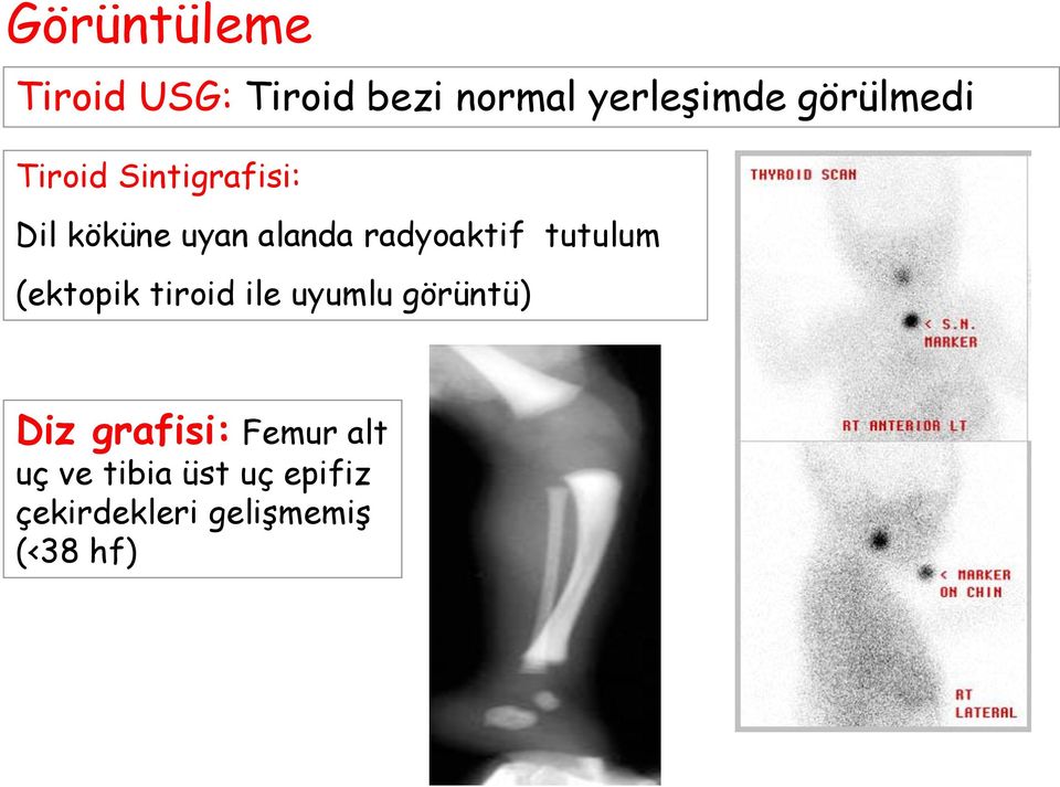 radyoaktif tutulum (ektopik tiroid ile uyumlu görüntü) Diz