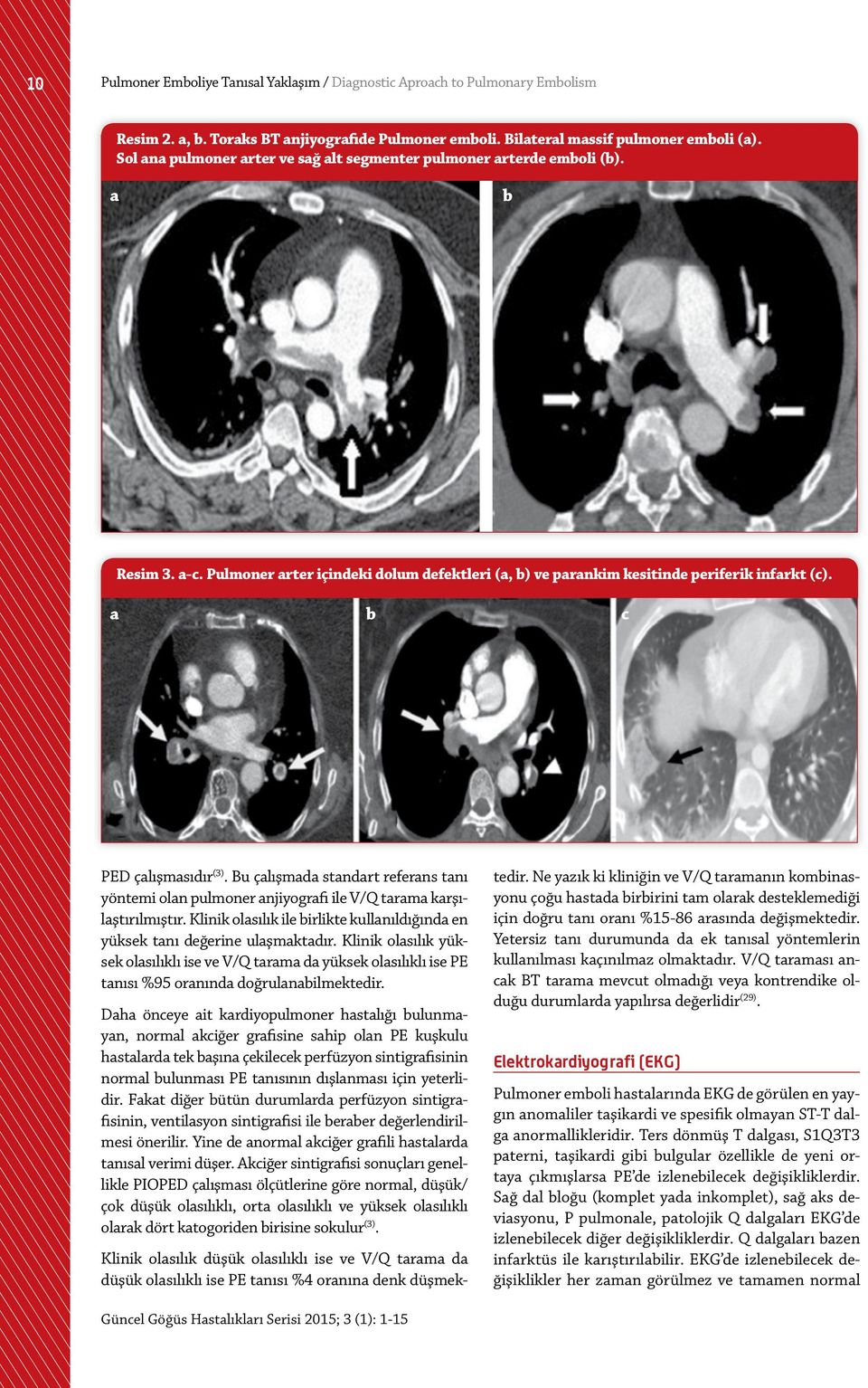 a b c PED çalışmasıdır (3). Bu çalışmada standart referans tanı yöntemi olan pulmoner anjiyografi ile V/Q tarama karşılaştırılmıştır.