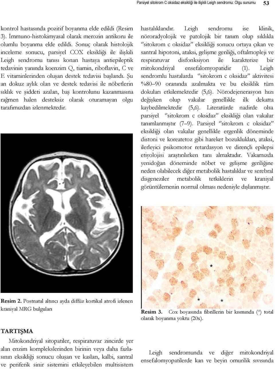 Sonuç olarak histolojik inceleme sonucu, parsiyel COX eksikliği ile ilişkili Leigh sendromu tanısı konan hastaya antiepileptik tedavinin yanında koenzim Q, tiamin, riboflavin, C ve E vitaminlerinden