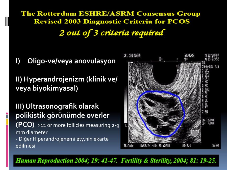 polikistik görünümde overler (PCO) >12 or more follicles