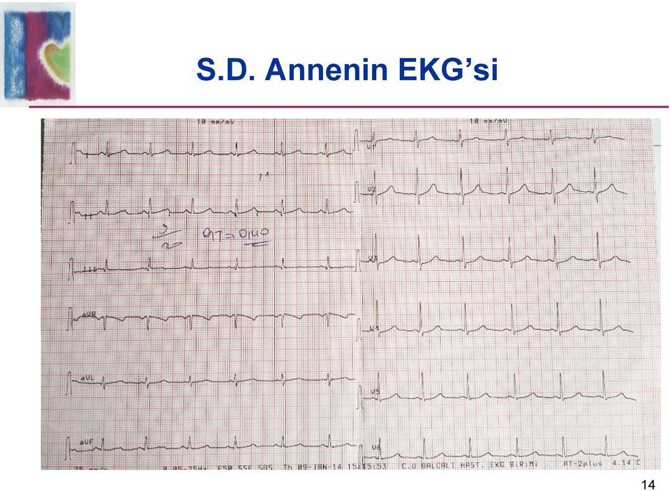 EKG si 14