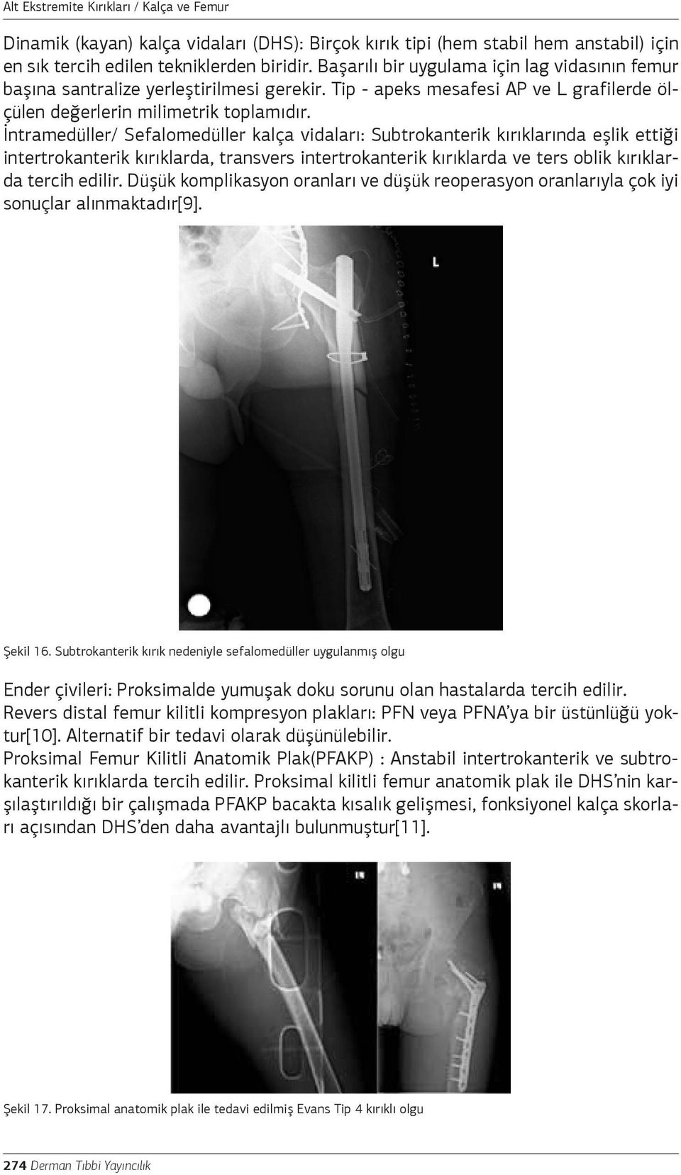 İntramedüller/ Sefalomedüller kalça vidaları: Subtrokanterik kırıklarında eşlik ettiği intertrokanterik kırıklarda, transvers intertrokanterik kırıklarda ve ters oblik kırıklarda tercih edilir.