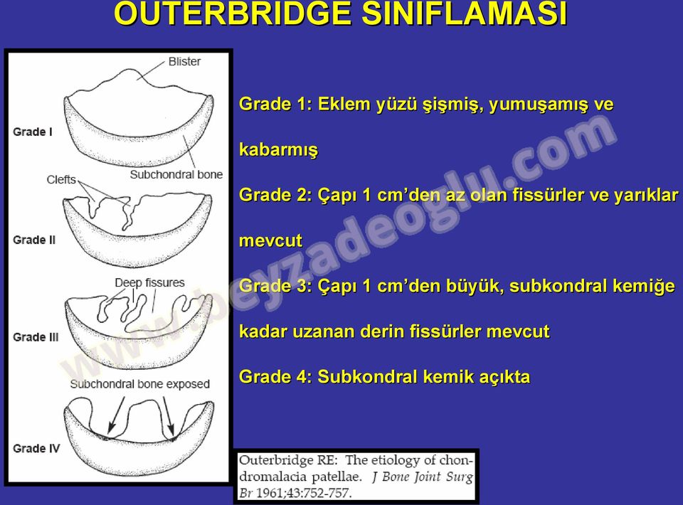 yarıklar mevcut Grade 3: Çapı 1 cm den büyük, subkondral