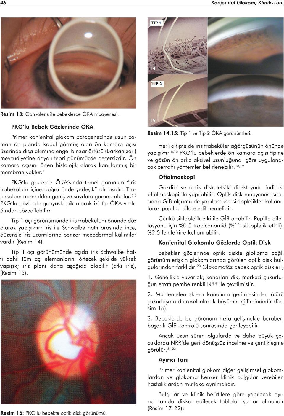 teori günümüzde geçersizdir. Ön kamara açısını örten histolojik olarak kanıtlanmış bir membran yoktur. 1 PKG lu gözlerde ÖKA sında temel görünüm iris trabekülum içine doğru önde yerleşik olmasıdır.