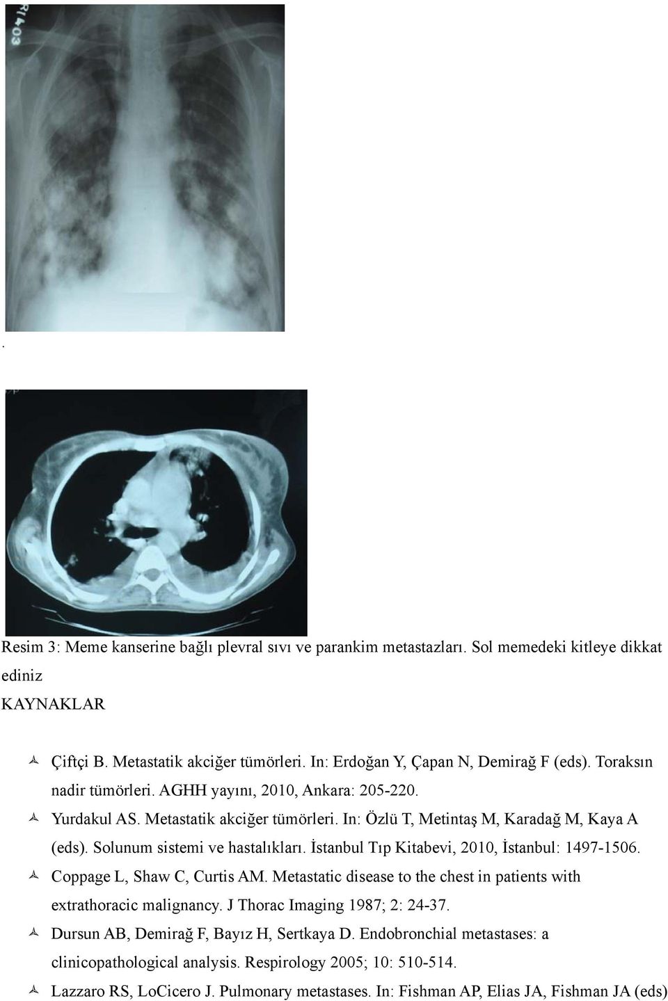 İstanbul Tıp Kitabevi, 2010, İstanbul: 1497-1506. Coppage L, Shaw C, Curtis AM. Metastatic disease to the chest in patients with extrathoracic malignancy. J Thorac Imaging 1987; 2: 24-37.