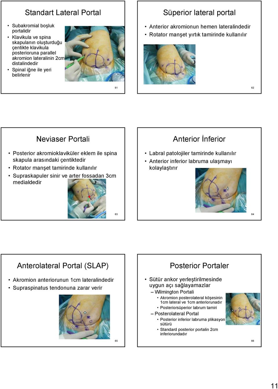 arasındaki çentiktedir Rotator manşet tamirinde kullanılır Supraskapuler sinir ve arter fossadan 3cm medialdedir Anterior İnferior Labral patolojiler tamirinde kullanılır Anterior inferior labruma