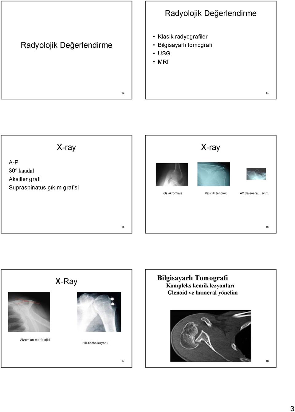 Kalsifik tendinit AC dejeneratif artrit 15 16 X-Ray Bilgisayarlı Tomografi Bilgisayarlı Tomografi