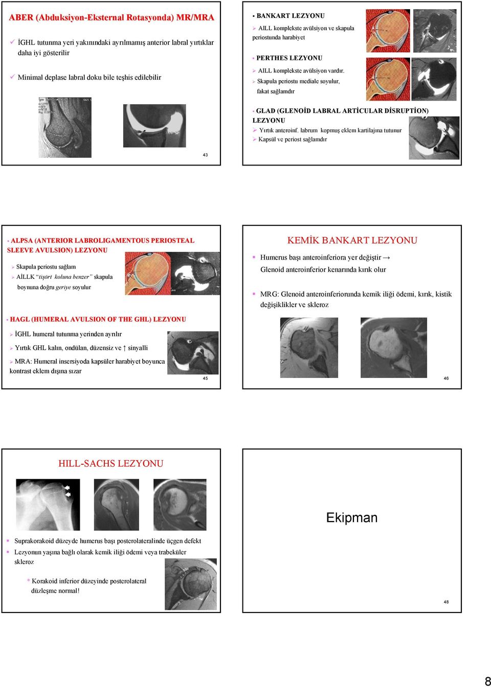 Skapula periostu mediale soyulur, fakat sağlamdır GLAD (GLENOİD LABRAL ARTİCULAR DİSRUPTİON) LEZYONU Yırtık anteroinf.