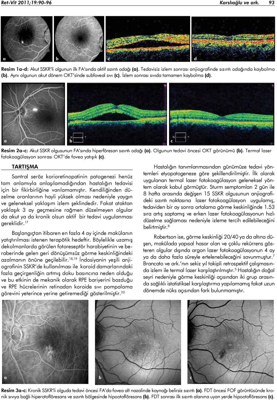 Olgunun tedavi öncesi OKT görünümü (b). Termal laser fotokoagülasyon sonrası OKT de fovea yatışık (c).