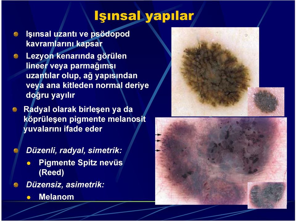 doğru yayılır Radyal olarak birleşen ya da köprüleşen pigmente melanosit yuvalarını