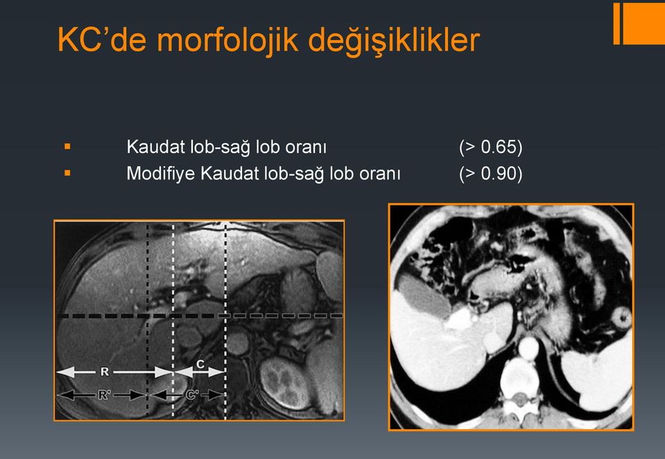 lob-sağ lob oranı (> 0.