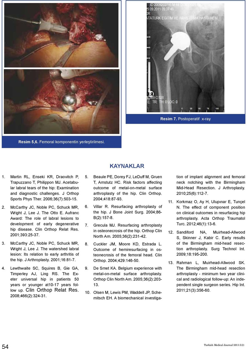 Aufranc Award: The role of labral lesions to development of early degenerative hip disease. Clin Orthop Relat Res. 2001;393:25-37. 3. McCarthy JC, Noble PC, Schuck MR, Wright J, Lee J.