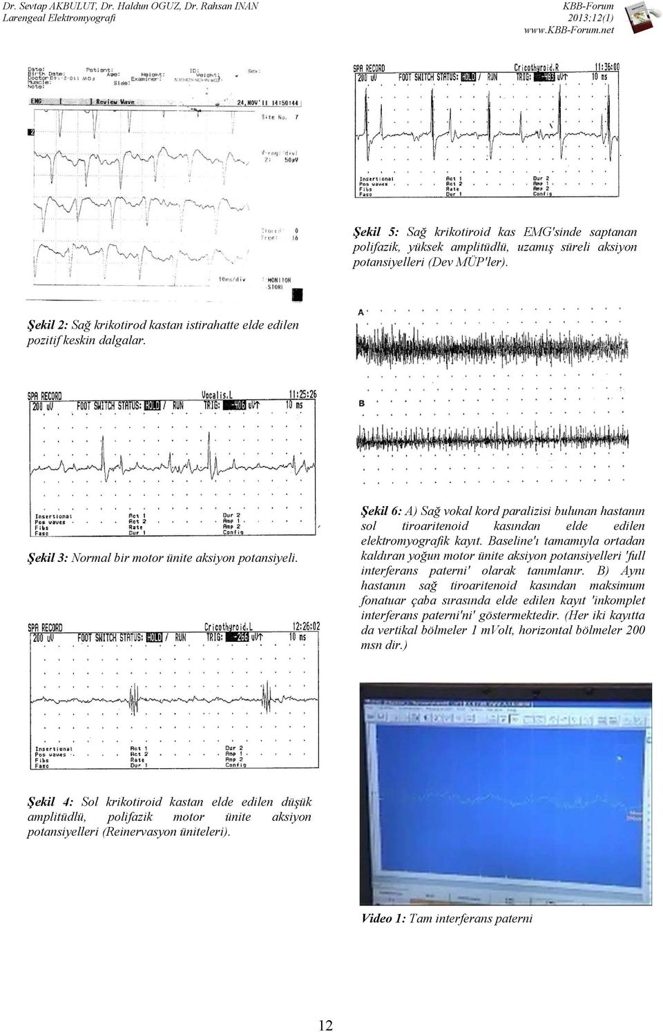 Şekil 6: A) Sağ vokal kord paralizisi bulunan hastanın sol tiroaritenoid kasından elde edilen elektromyografik kayıt.