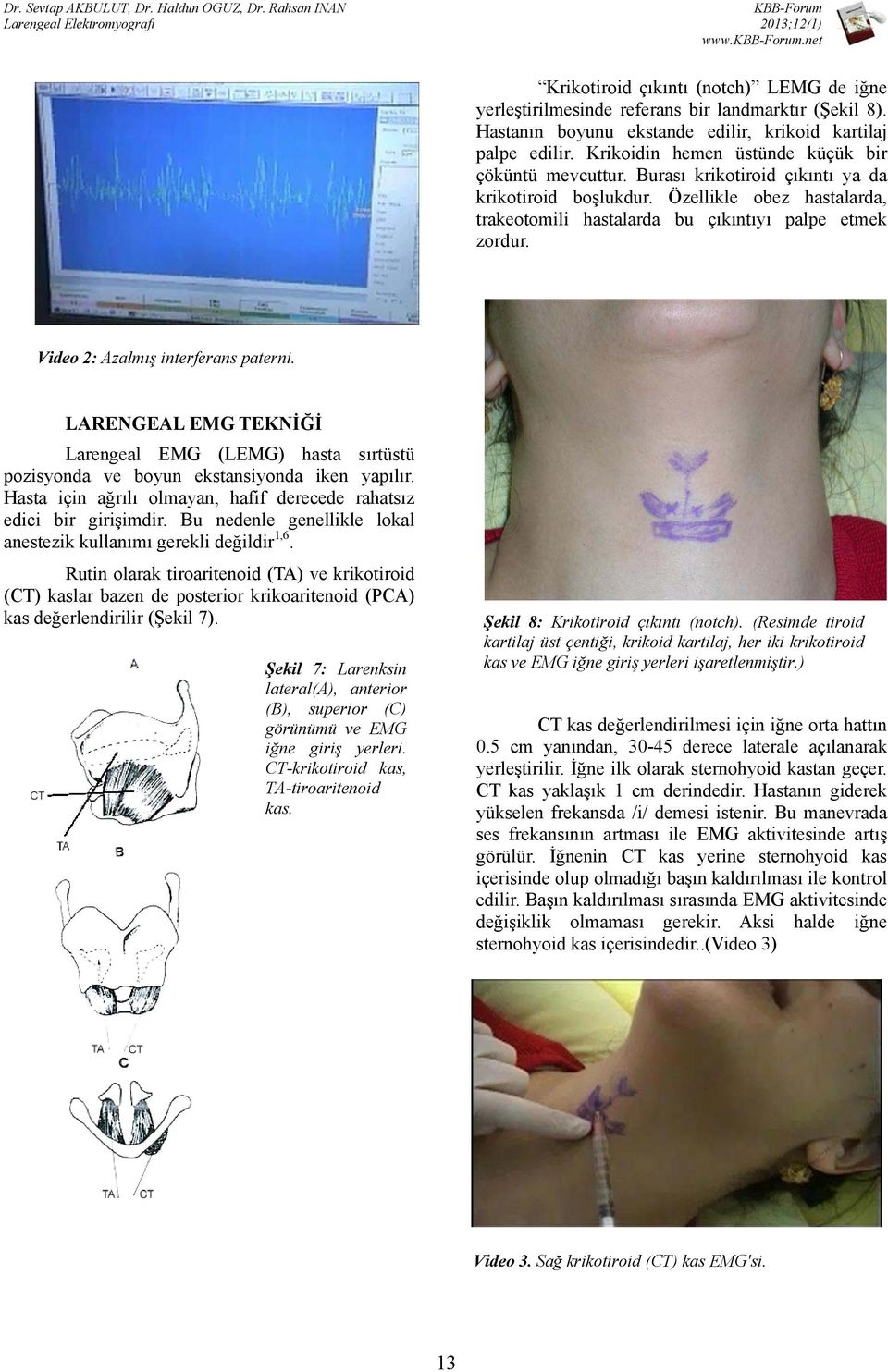 Video 2: Azalmış interferans paterni. LARENGEAL EMG TEKNİĞİ Larengeal EMG (LEMG) hasta sırtüstü pozisyonda ve boyun ekstansiyonda iken yapılır.