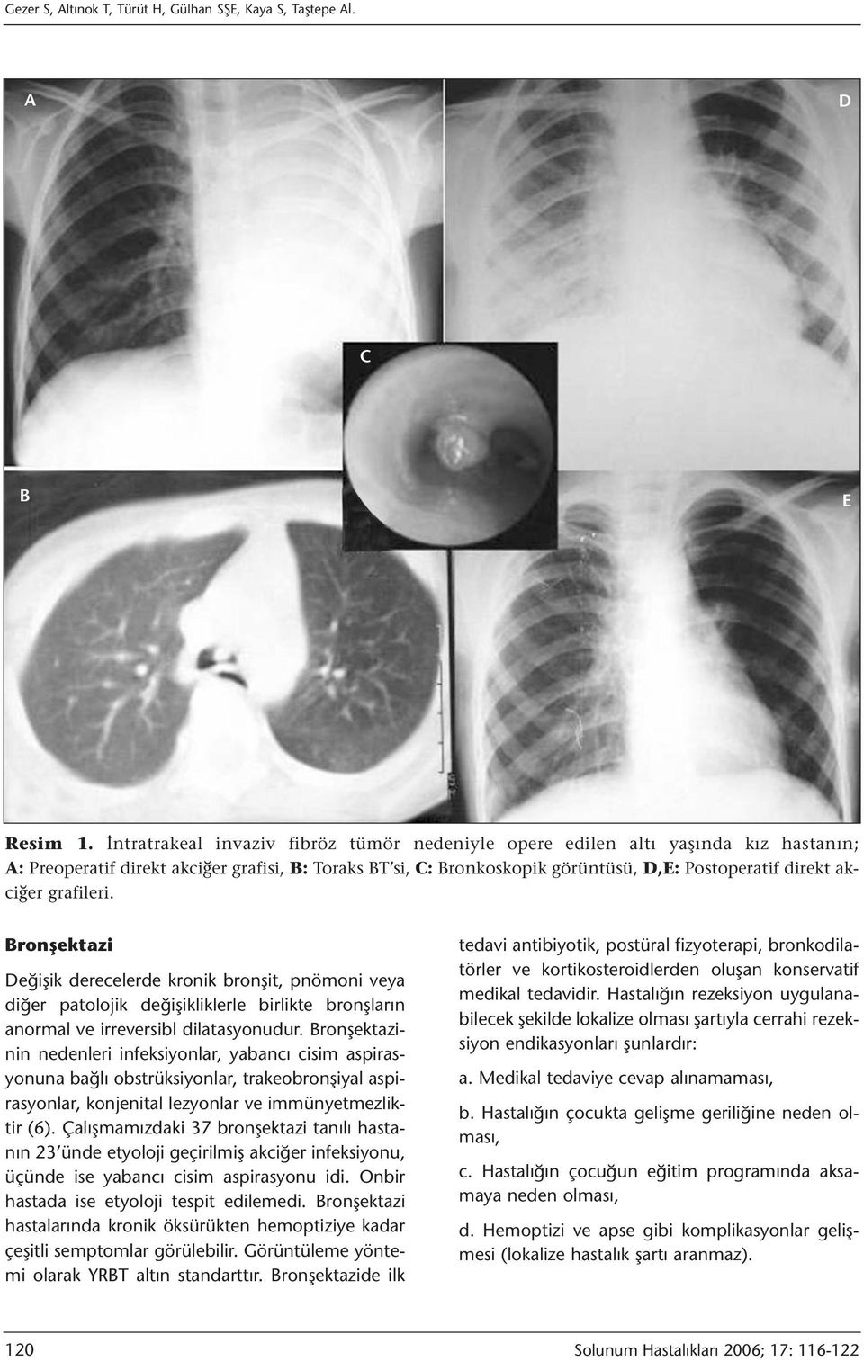 grafileri. Bronşektazi Değişik derecelerde kronik bronşit, pnömoni veya diğer patolojik değişikliklerle birlikte bronşların anormal ve irreversibl dilatasyonudur.