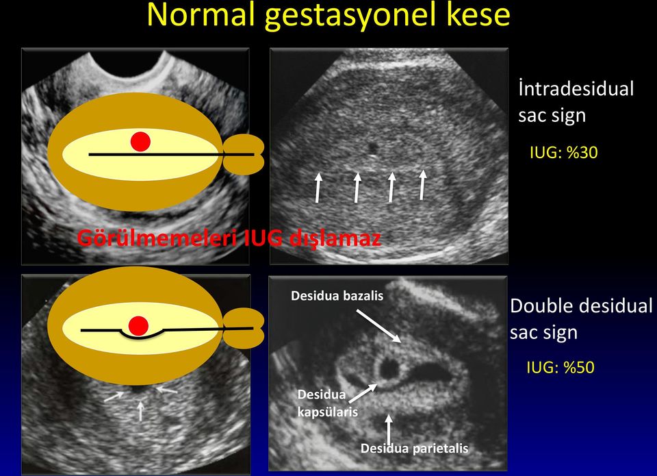 Desidua bazalis Desidua kapsülaris Double