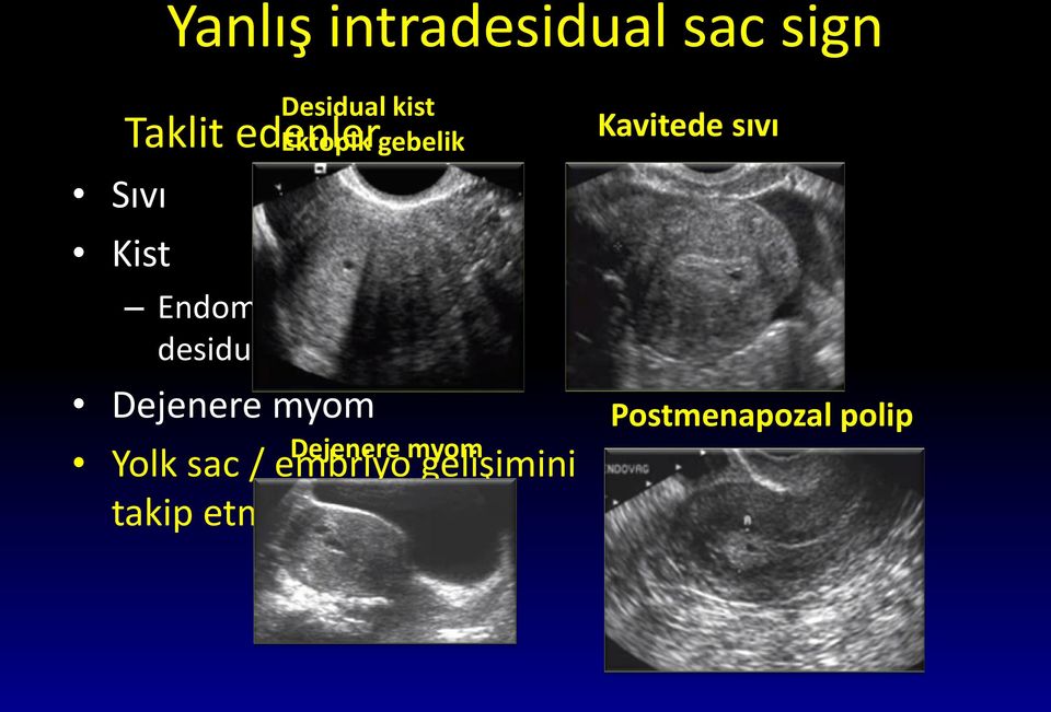 desidual Dejenere myom Dejenere myom Yolk sac / embriyo