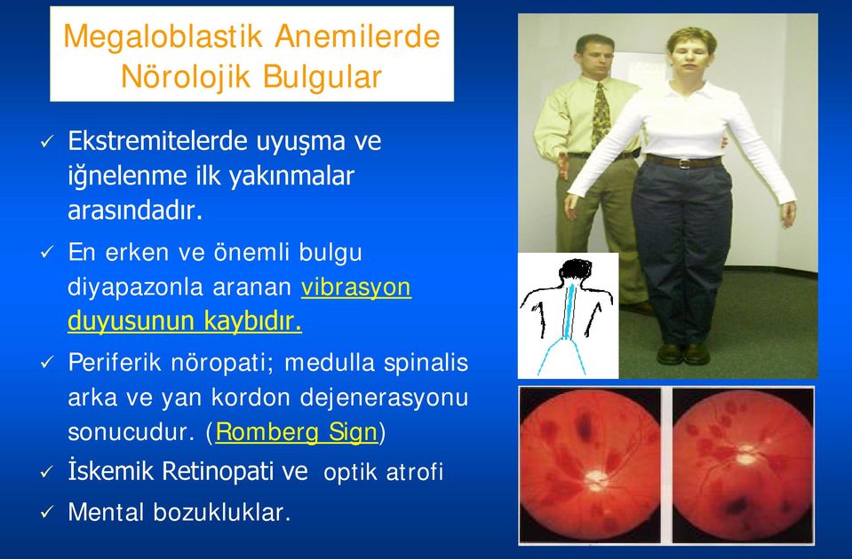 En erken ve önemli bulgu diyapazonla aranan vibrasyon duyusunun kaybıdır.